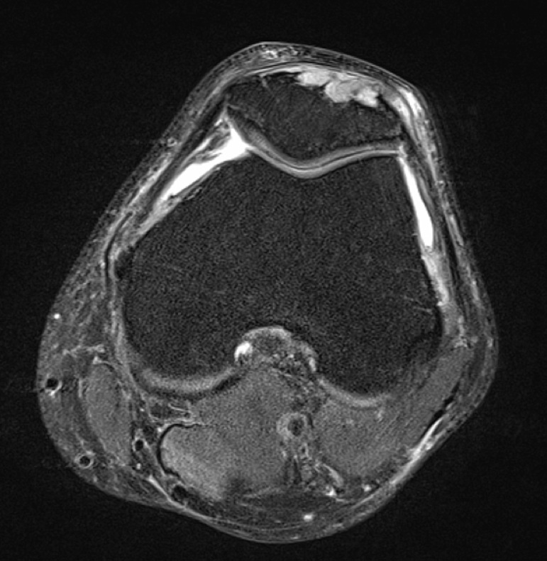 Figure 4 for case gout arthritis ( RID3567 )